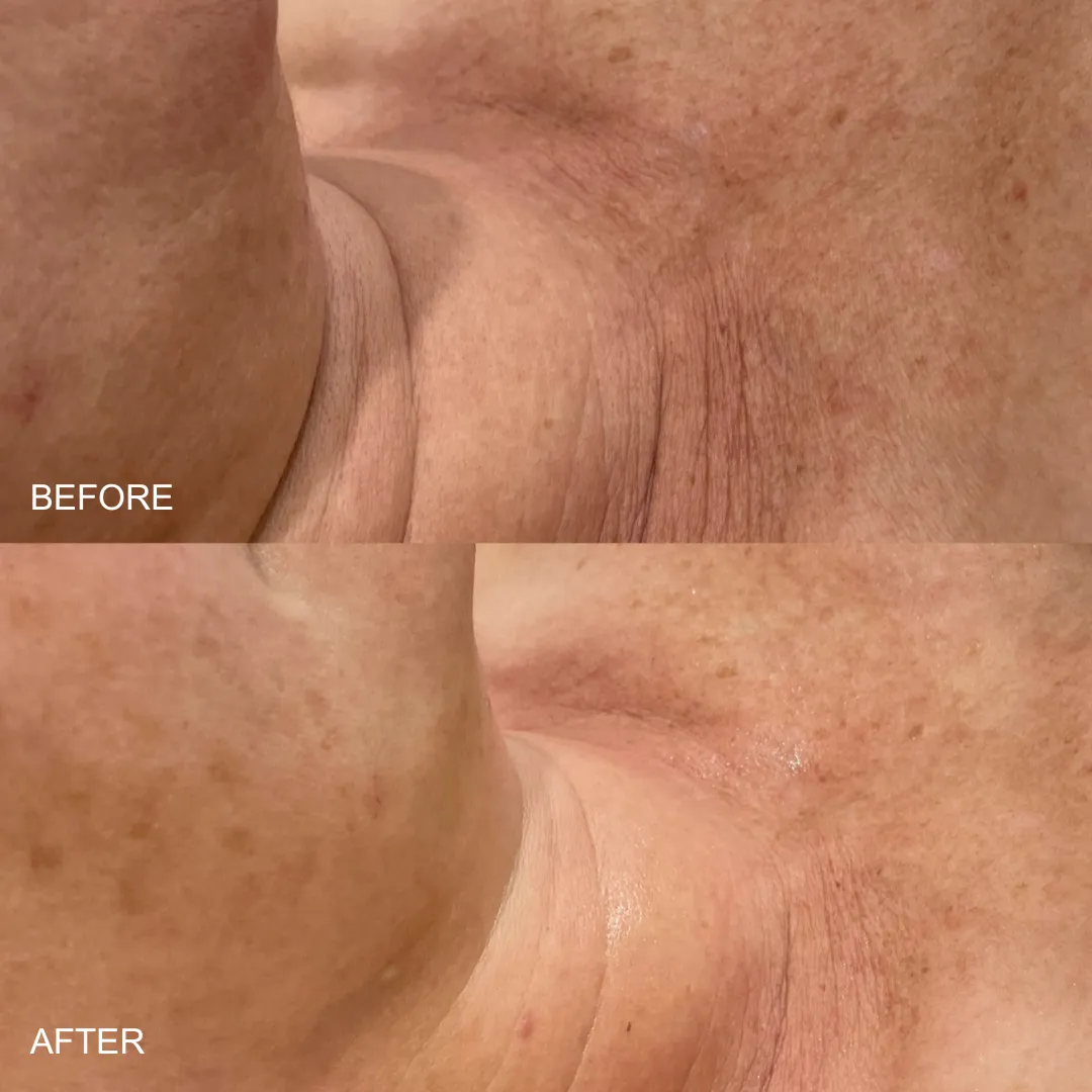 Before and after — neck crepiness and sun damage