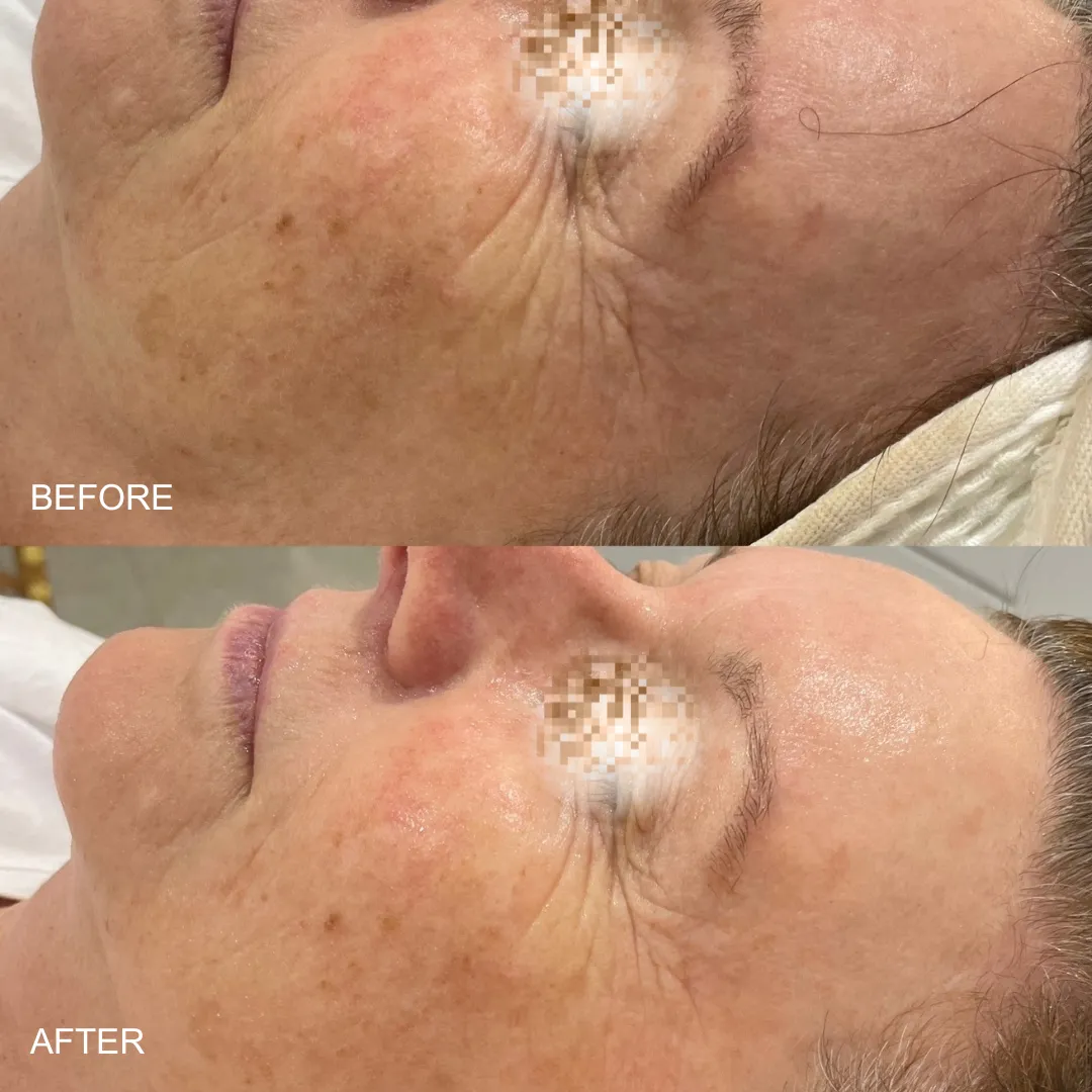 Before and after — pigmentation and fine lines around the eye