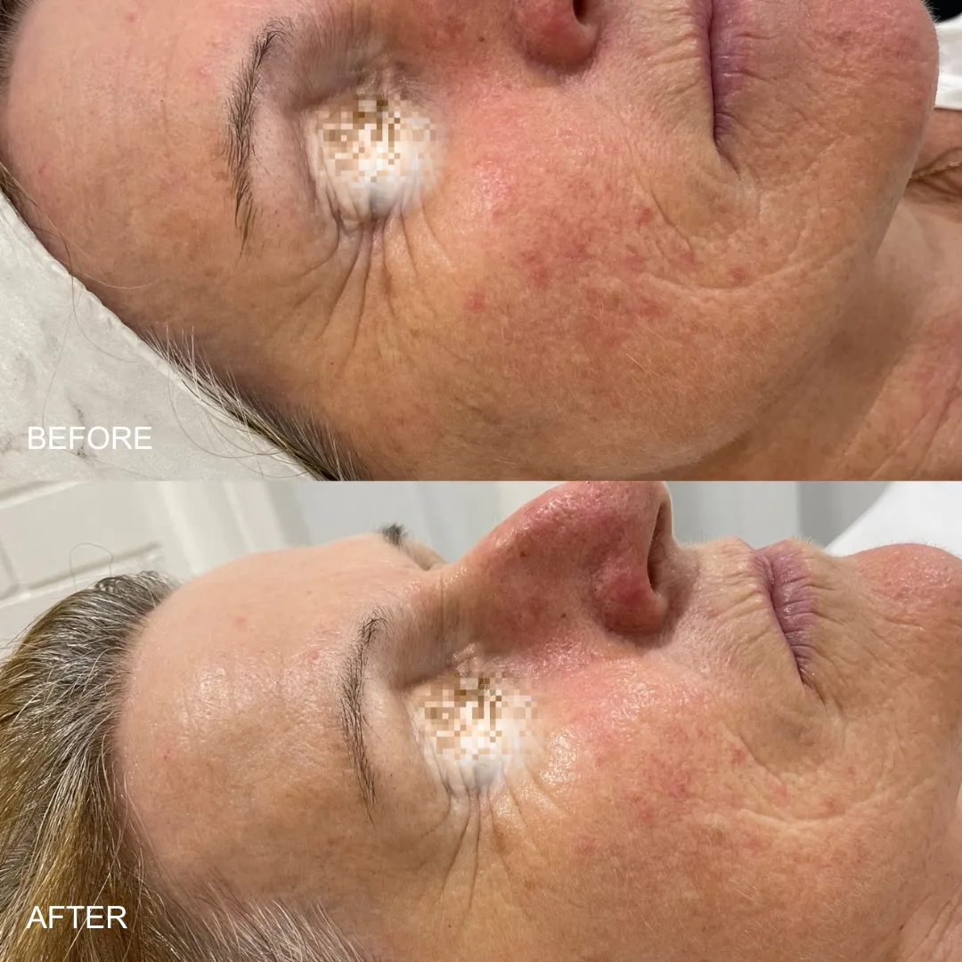 Before and after — redness and texture on the cheek
